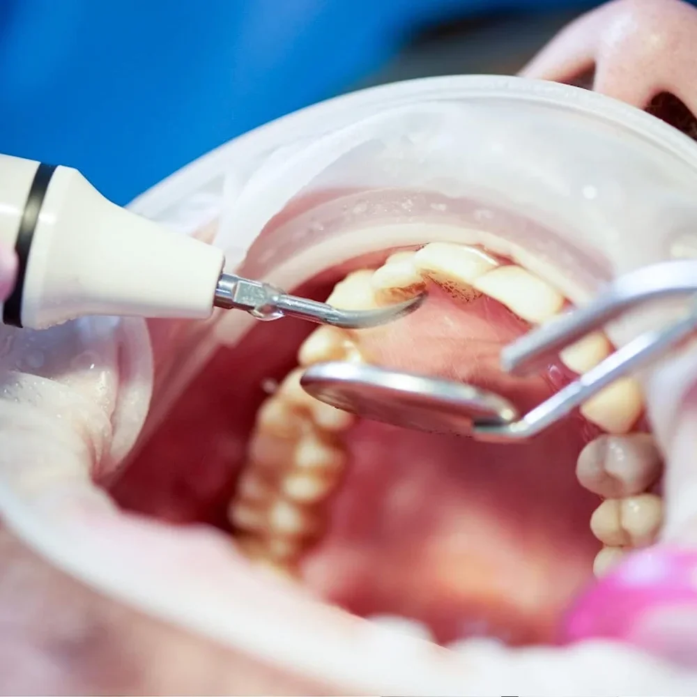 ELIJAH Dental Sugragingival Sc - مراجعة Thermal Paste وسعره
